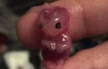 Elle prend une pilule abortive et voit son bébé de 7 semaines