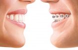 Orthodontie : broches ou pas de broches ?