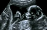 Ecosse : avortement sélectif jusqu’à la naissance en fonction du sexe